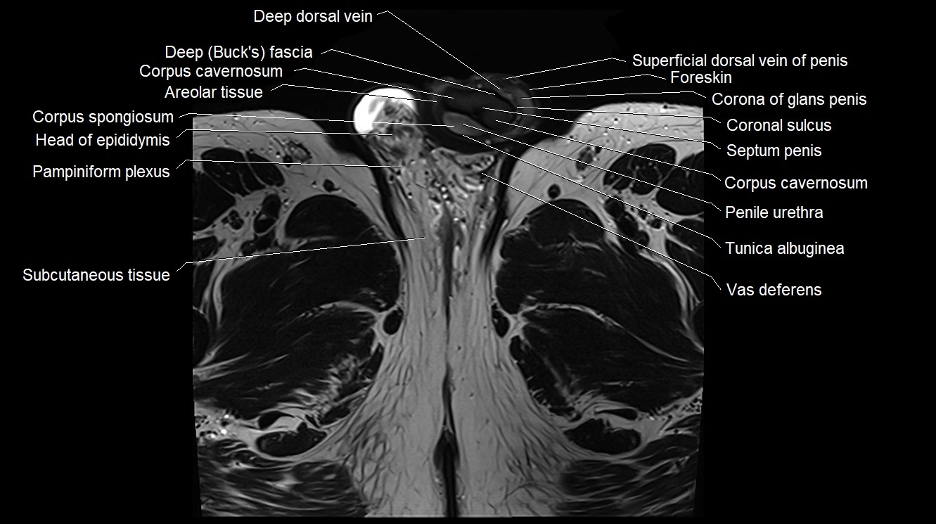 MRI 3T scrotum and penis axial cross sectional anatomy image 26.webp